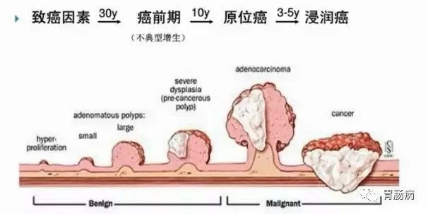 體檢查出腸息肉一定要切除！ 95%腸癌由它演變而來