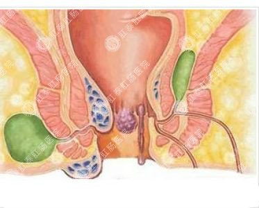 南寧哪個(gè)醫(yī)院可以做肛周膿腫？