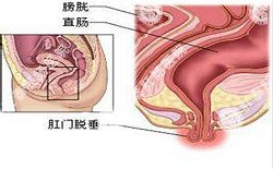 南寧治療脫肛哪家醫(yī)院好？南寧脫肛治療多少錢？